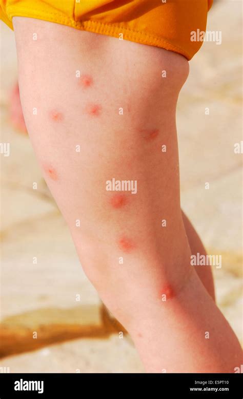 Mosquito Bites Allergic Reaction Rash