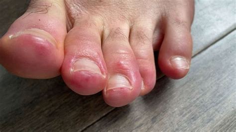 Covid Toes Could Skin Conditions Offer Coronavirus Clues Good