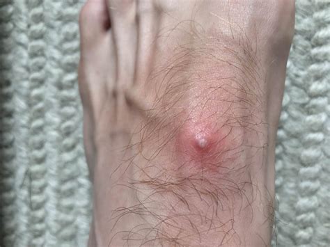 I Woke Up With This Bite On My Foot I Wasnt Sure But Is This A Spider