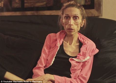 Anorexic Rachael Farrokh Makes Video For Help As She Is Too Skinny To