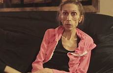 anorexia actress rachael farrokh anorexic woman who skinny plea dying she nervosa after weight rachel recovery emaciated pound her too