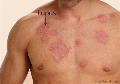 Penyebab Penyakit Lupus Newstempo