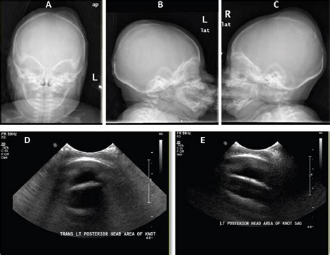 Calcified Cephalohematoma In A Newborn Unusual Presentation Without
