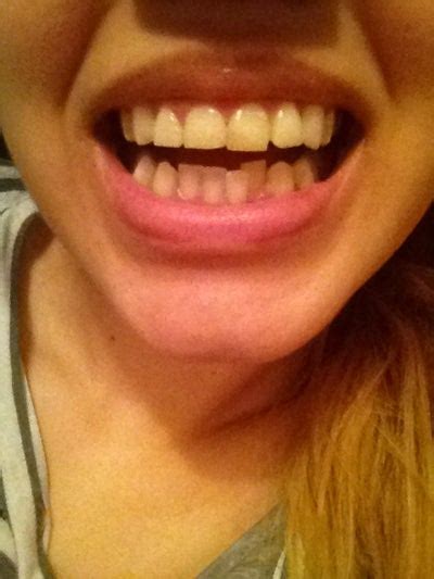 I Hate My Teeth Both Of My Front Teeth Are Bonded What Can I Do To Get Nice Straight Teeth