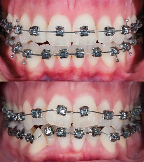 Before And After Life At Different Stages Of Braces Carlyle Orthodontics