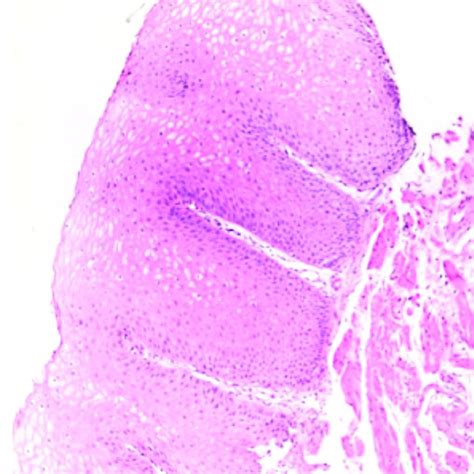 Marked Intraepithelial Eosinophilia And Eosinophilic Microabscesses