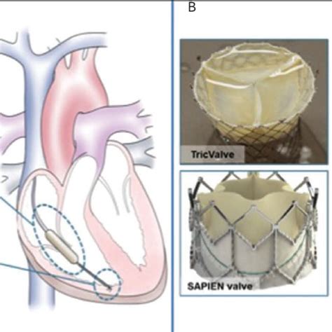 Transcatheter Tricuspid Valve Repair Devices A Caval Implant And B