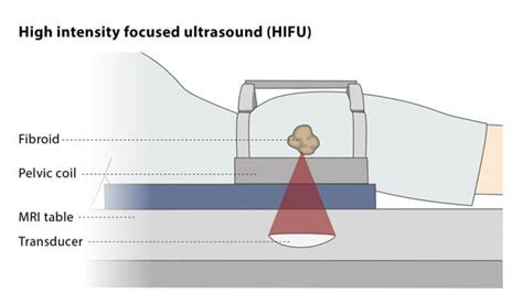 High Intensity Focused Ultrasound Hifu Cirse