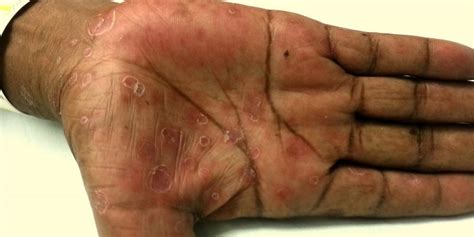 All About Syphilis Hand Rash And Other Symptoms Pulselive Kenya