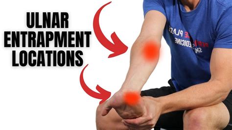 Ulnar Nerve Entrapment Treatment How To Treat Pinky And Ring Finger
