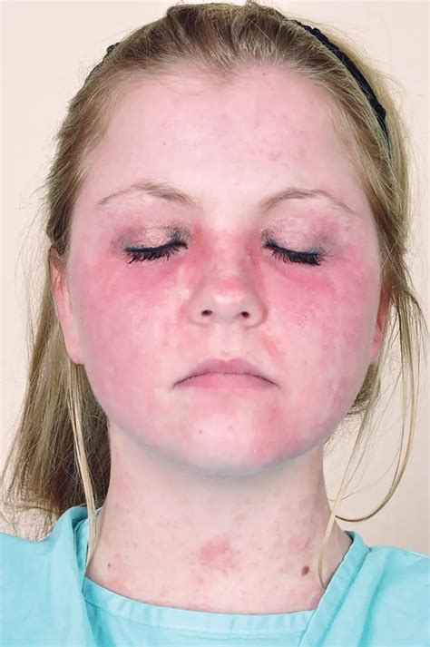 Allergic Contact Dermatitis American Academy Of Ophthalmology