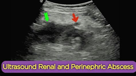 Ultrasound Renal Perinephric Abscess Youtube