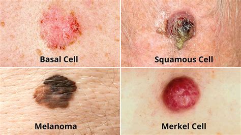 皮肤癌的类型：黑色素瘤，基底和鳞状细胞癌日常健康 Vwin App