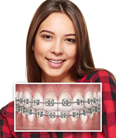 Types Of Braces Costa Orthodontic Specialist Bryn Mawr Pennsylvania