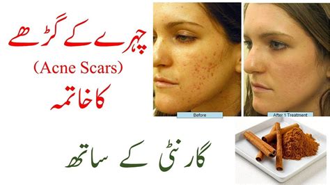 How To Remove Acne Scars 100 Effective Result Youtube