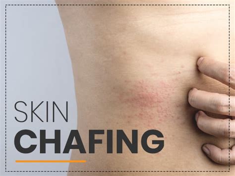 Chafing Causes Symptoms Complications Treatment And Prevention