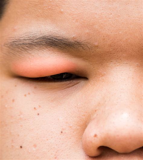 Bed Bug Bites On Eyelid