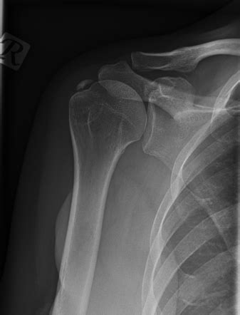 Calcific Tendonitis Of The Supraspinatus Tendon Radiology Case