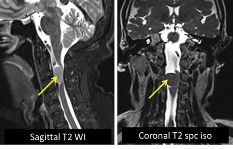 Spinal Meningioma Radiology Cases