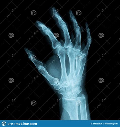 X Ray Image Of A Human Right Hand For A Medical Diagnosis Stock Image