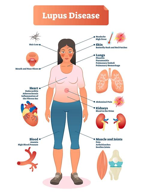 Lupus Symptoms 10 Warning Signs And Symptoms Of Lupus Healthella