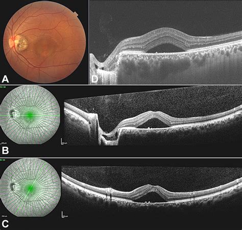 Central Serous Chorioretinopathy In A Patient Of Juxtapapillary