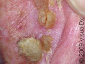Actinic Keratosis Solar Keratosis Condition Treatments And Pictures For Adults Skinsight