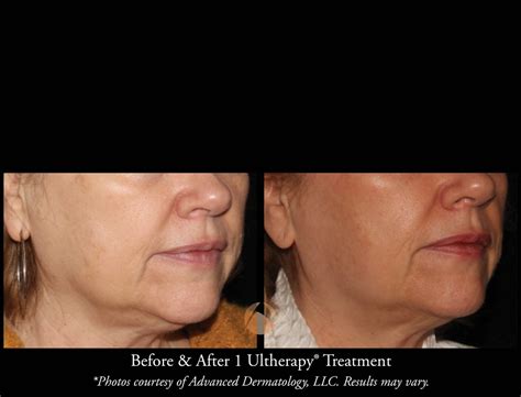 Ultherapy Skin Tightening Procedure Chicago Il Advanced Dermatology