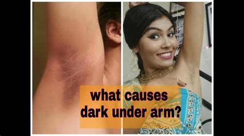 What Causes Dark Underarm Armpit 5 Most Common Factors Linked To Underarm Darkening Youtube