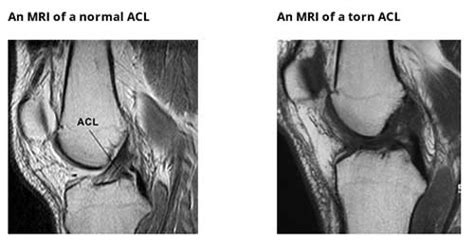 Anterior Cruciate Ligament Acl Surgeons And Consultants Yorkshire