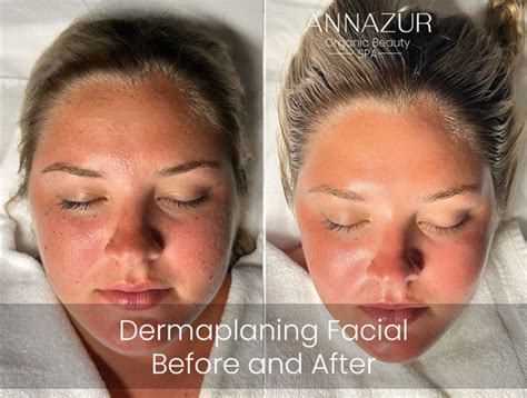 Dermaplaning Facial Price Reviews Annazur