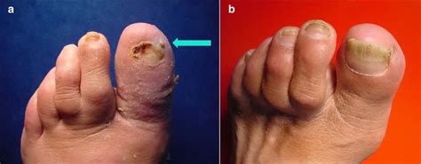A B Left Foot Of The Patient A 1st Toe At Initial Visit Sausage