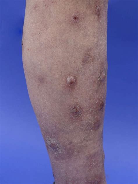 Figure Prurigo Nodularis Contributed By Dermnetnz Statpearls