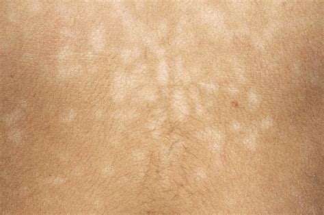 Pityriasis Versicolor What Is It Symptoms And Treatment Mediologiest