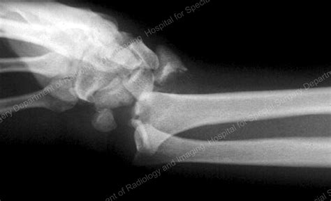 Avoiding Distal Radius Fracture Complications Broken Wrist