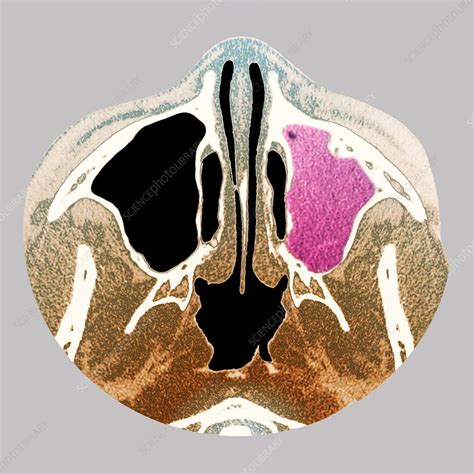 Sinus Infection CT Scan Stock Image C Science Photo Library