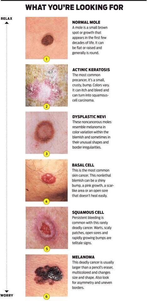 Different Types Of Skin Cancer What To Look For Trusper