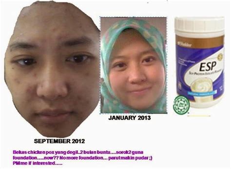 Tidak susah nak hilangkan parut demam campak chicken pox ini. Parut Chicken Pox.....Jangan Risau Shaklee Kan Ada ...