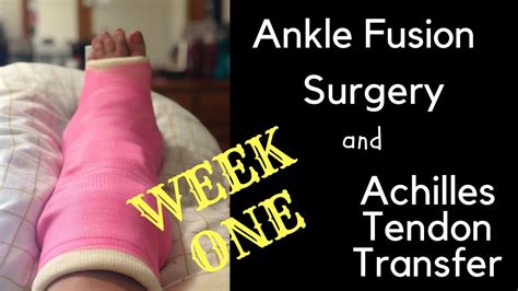 During this time, your tendon grows back together. Ankle Fusion Surgery, bone graft and achilles tendon ...