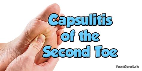 Capsulitis Of The Second Toe Causes Symptoms And Treatments