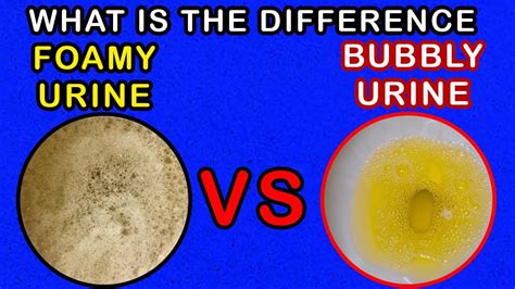 Differences Between Foamy Urine Vs Bubbly Urine Youtube