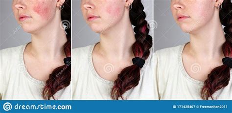 A Series Of Images Of A Young Caucasian Woman`s Face Showing Redness