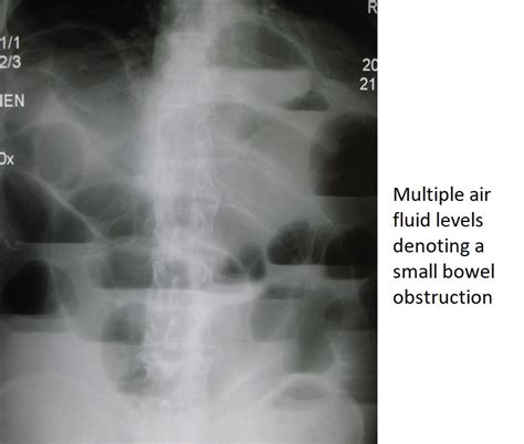 Bowel Obstruction X Ray Wikidoc