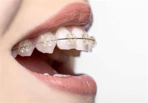 What Is “accelerated Orthodontics” And How Does It Work Orthodontic Associates