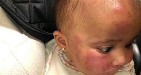 New Jersey Daycare Shuts Down After Baby Comes Homes Covered With Bite