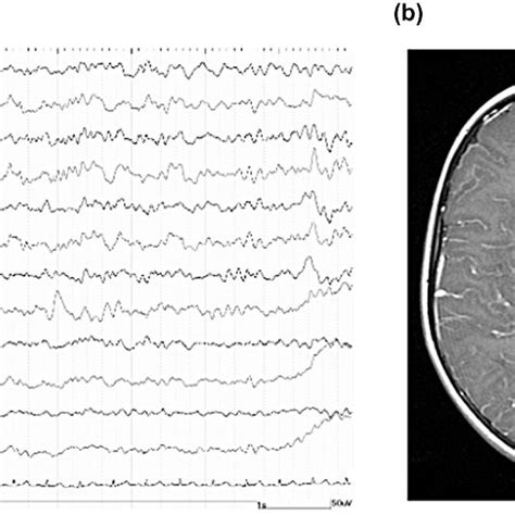 Results Of Electroencephalography Eeg And Brain Magnetic Resonance Download Scientific