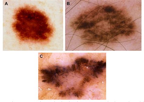 Figure 1 From Dermatoscopy For Melanoma And Pigmented Lesions