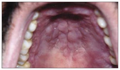 A 33 Year Old Male Farmer With Progressive Gingival Swelling And