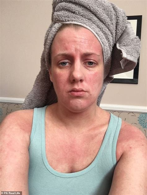Woman Shows Red Raw Skin After Ditching Eczema Steroid Creams