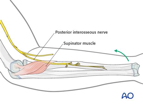 Posterior Interosseous Nerve Entrapment Elbow Pain Physiotherapy